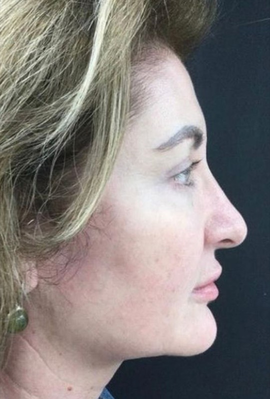 Upper & Lower Blepharoplasty, after