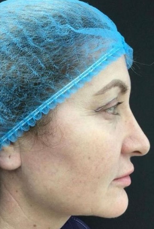 Upper & Lower Blepharoplasty, before