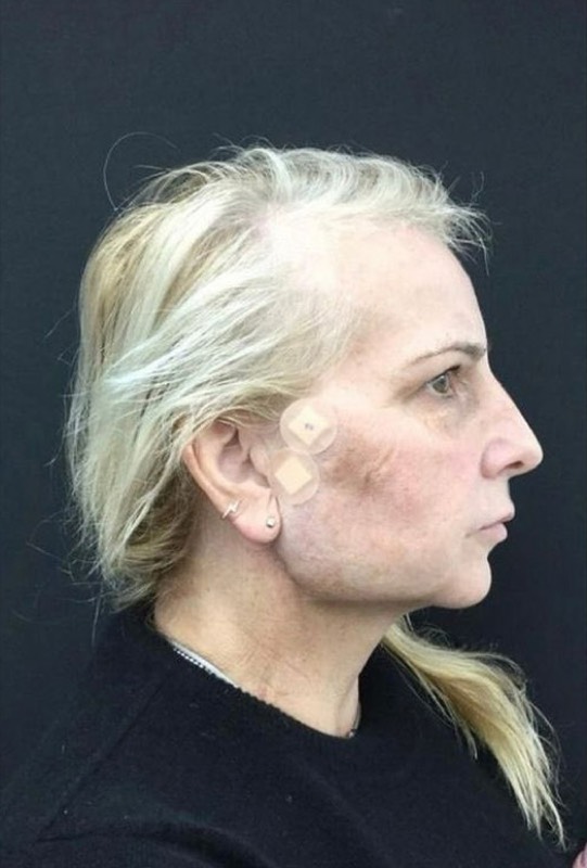 Lift, Tighten & Rejuvenate, after