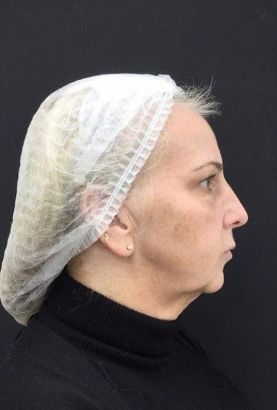 Lift, Tighten & Rejuvenate, before