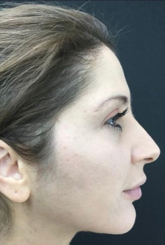 Lower Face Rejuvenation, after