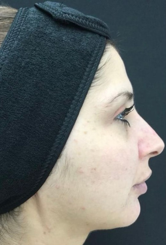 Lower Face Rejuvenation, before